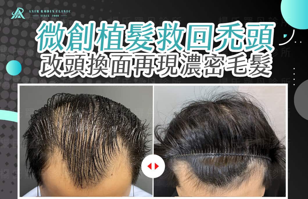 【植髮】FUE微創植髮救回禿頭，改頭換面再現濃密毛髮