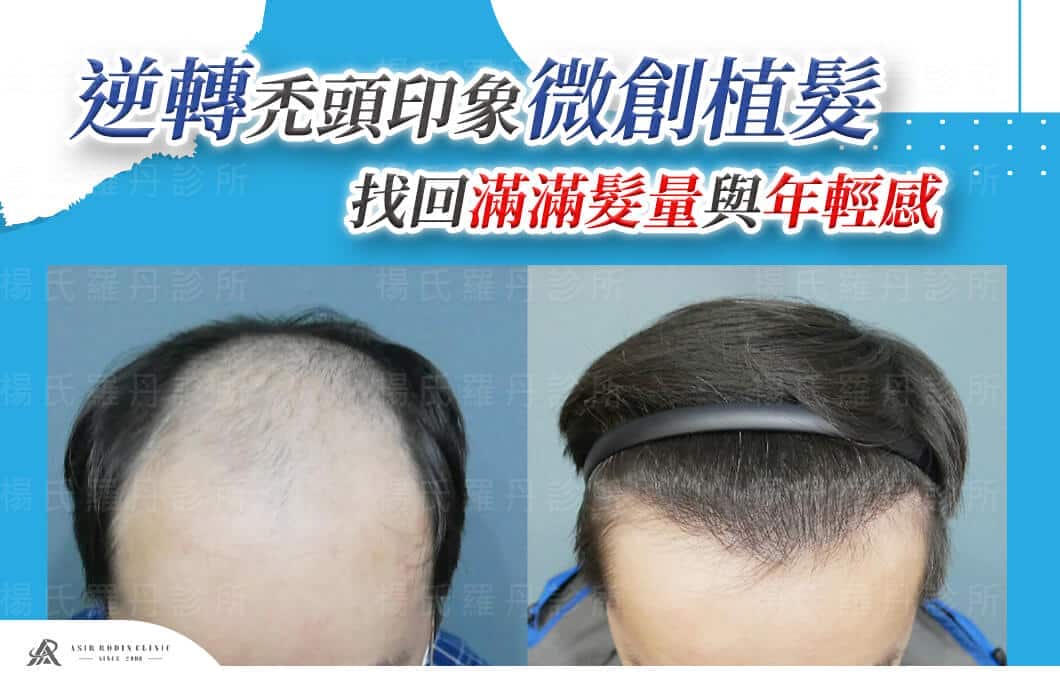 【植髮】逆轉禿頭印象，微創植髮找回滿滿髮量與年輕感