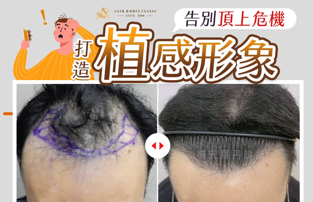【植髮】雄性禿不再撤退！打造「植」感形象，告別頂上危機