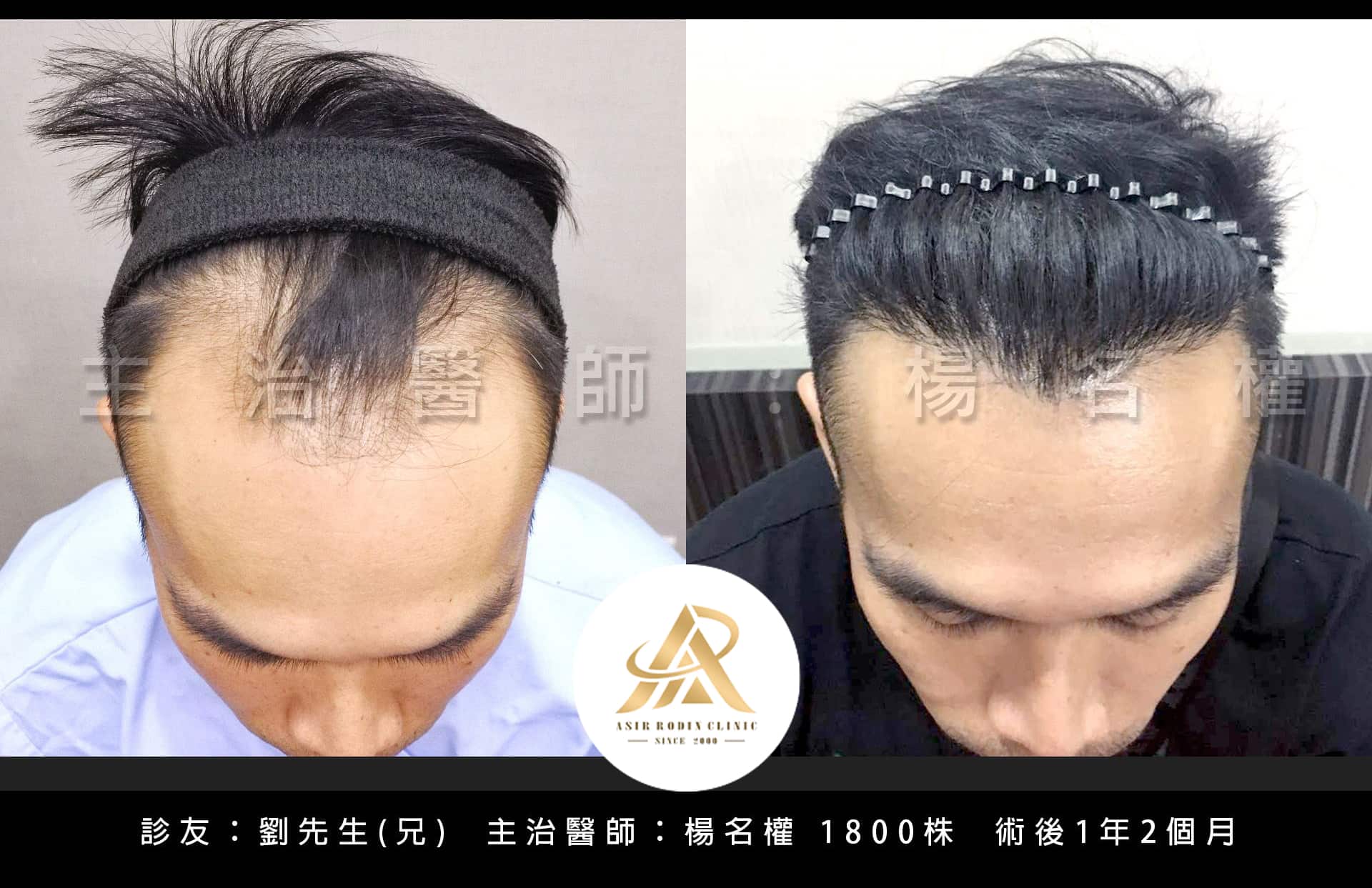 【植髮】植髮前後，回歸年輕判若兩人！