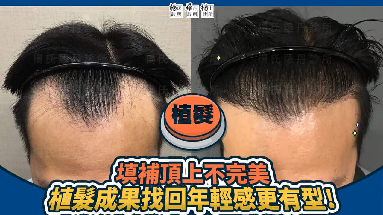 【植髮】填補頂上不完美，植髮成果找回年輕感更有型!