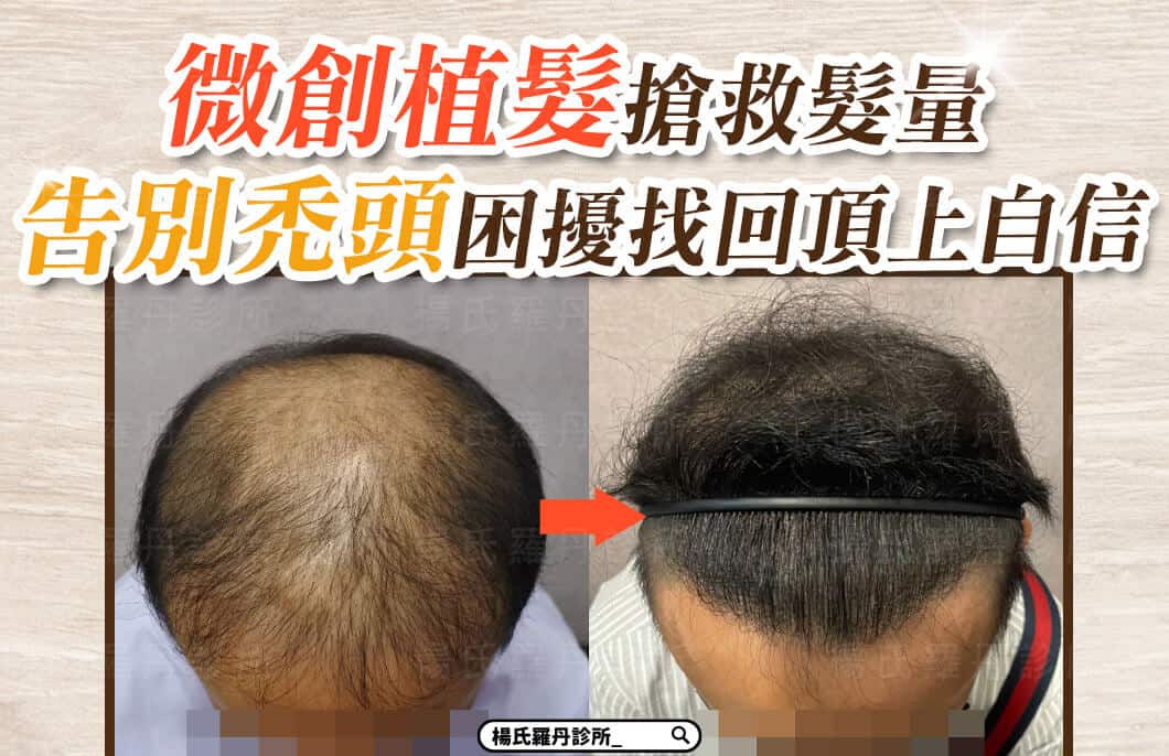 【植髮】微創植髮搶救髮量，告別禿頭困擾找回頂上自信