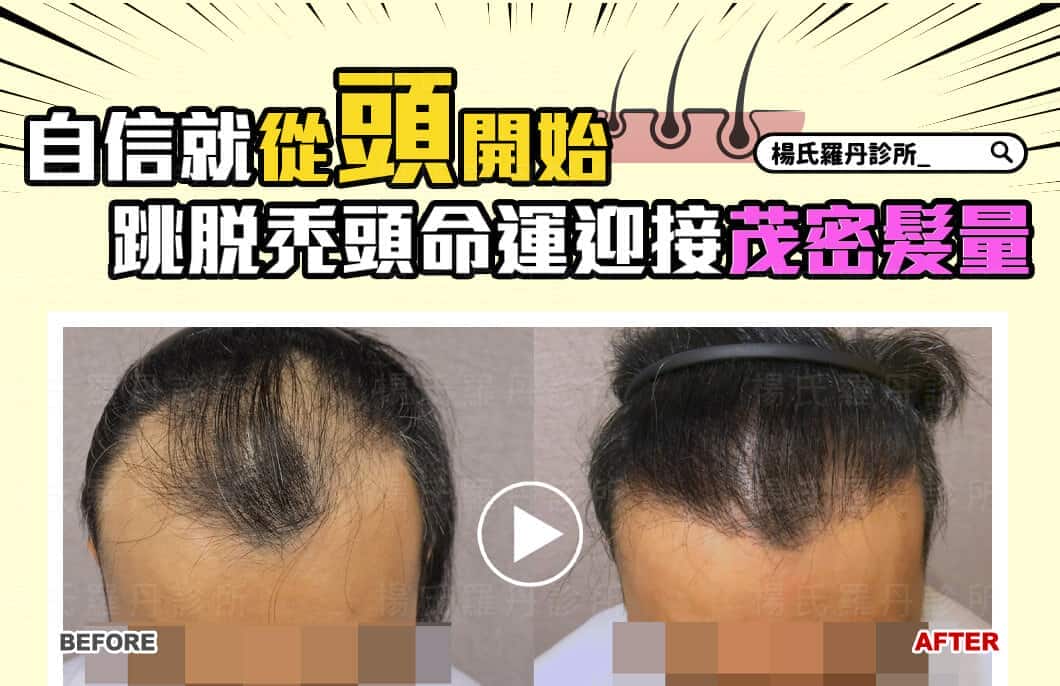 【植髮】自信就從「頭」開始，跳脫禿頭命運迎接茂密髮量