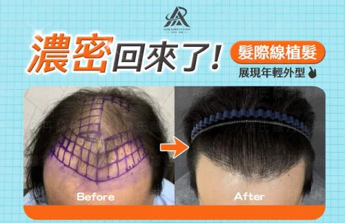【植髮】濃密髮型回來了！髮際線植髮輕鬆展現年輕外型