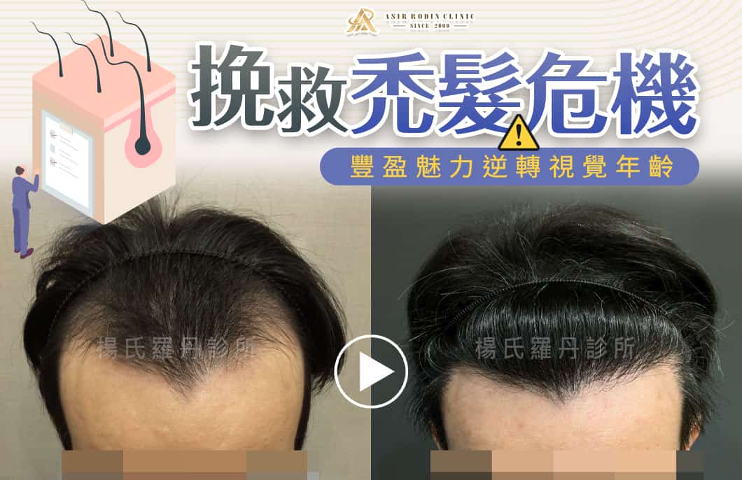【植髮】挽救禿髮危機拒絕顯老，豐盈魅力逆轉視覺年齡