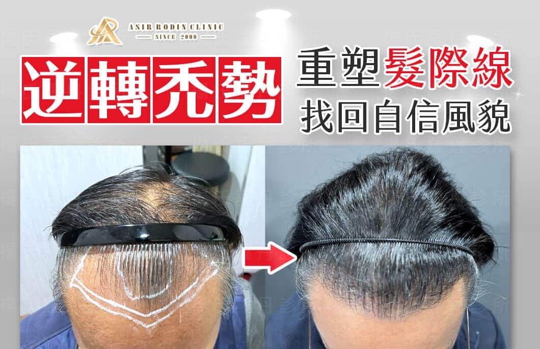 【植髮】逆轉禿勢，重塑自然髮際線，找回年輕自信風貌