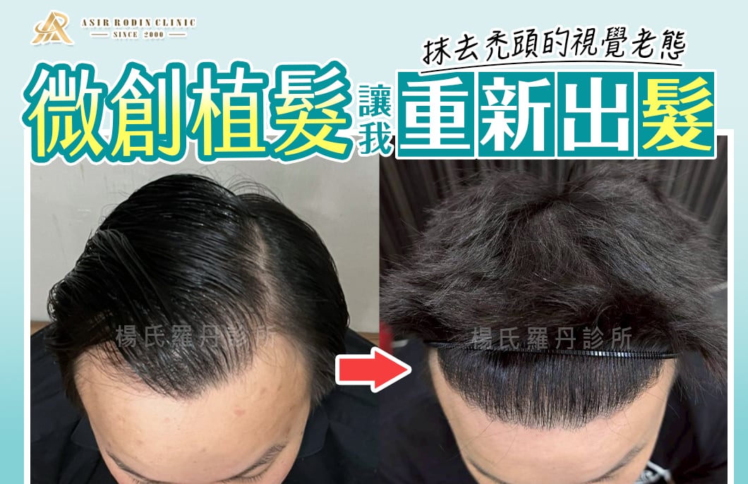 【植髮】抹去禿頭的視覺老態，微創植髮讓我重新出「髮」