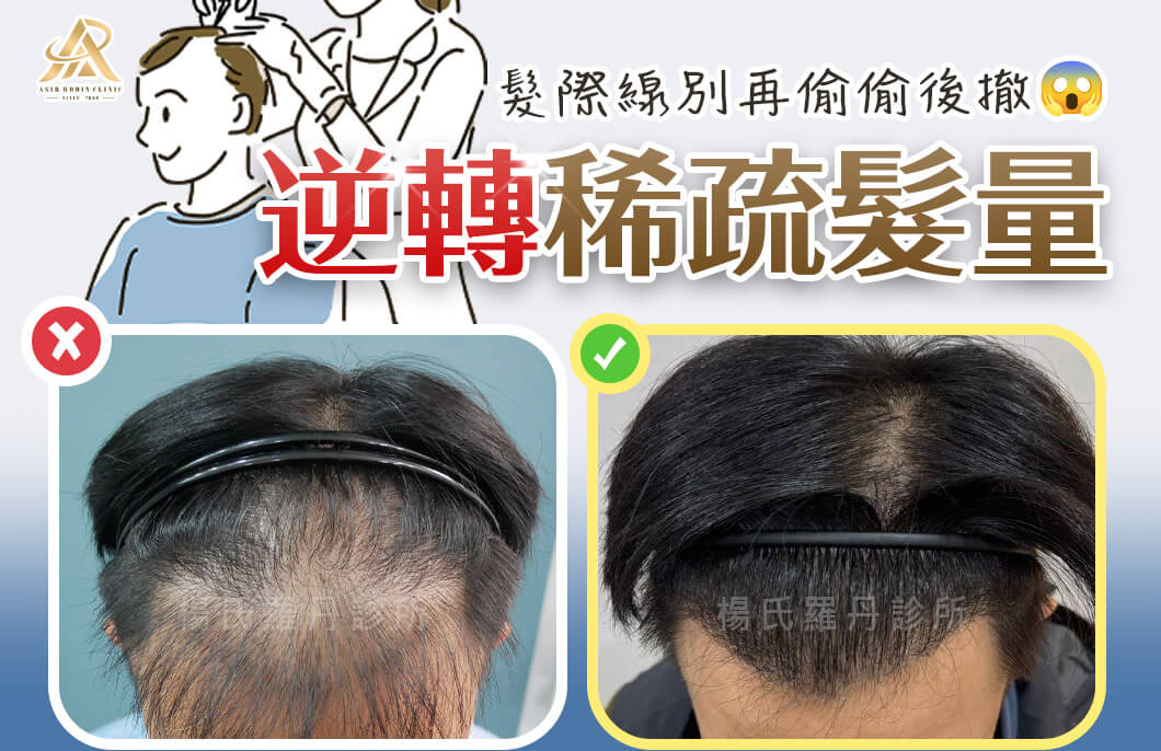 【植髮】髮際線別再偷偷後撤，逆轉稀疏髮量自信upup