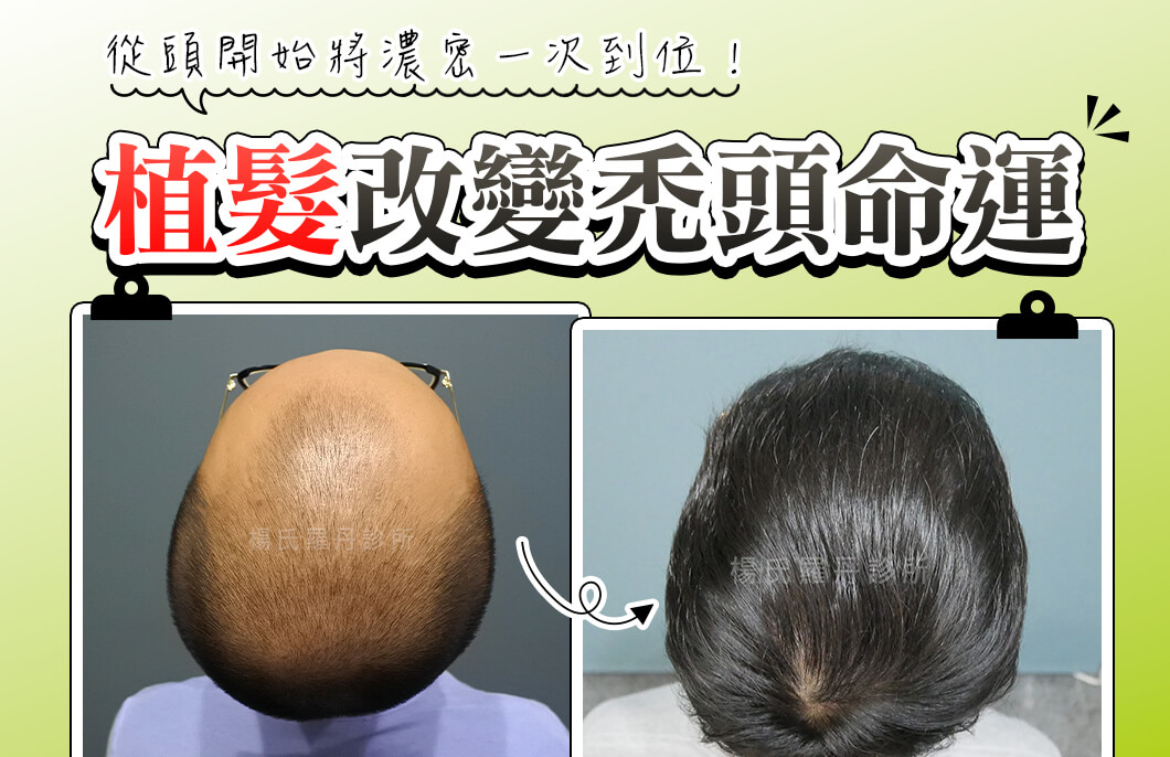 【植髮】植髮改變禿頭命運，從頭開始將濃密一次到位！