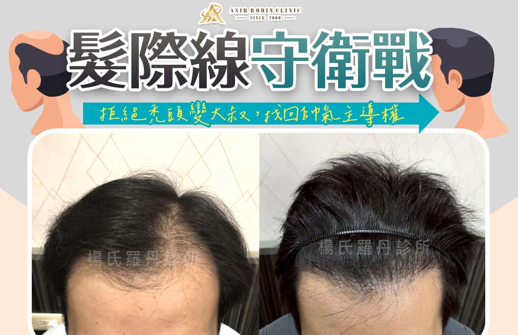 【植髮】髮際線守衛戰！拒絕禿頭變大叔，找回帥氣主導權