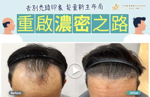 【植髮】告別禿頭印象，髮量新生布局，重啟濃密之路！