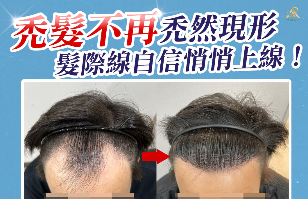 【植髮】禿髮不再禿然現形，重整髮際線自信悄悄上線！
