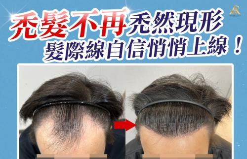 【植髮】禿髮不再禿然現形，重整髮際線自信悄悄上線！