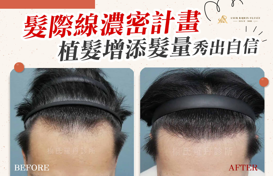 【植髮】重啟髮際線濃密計畫，植髮增添髮量秀出自信！