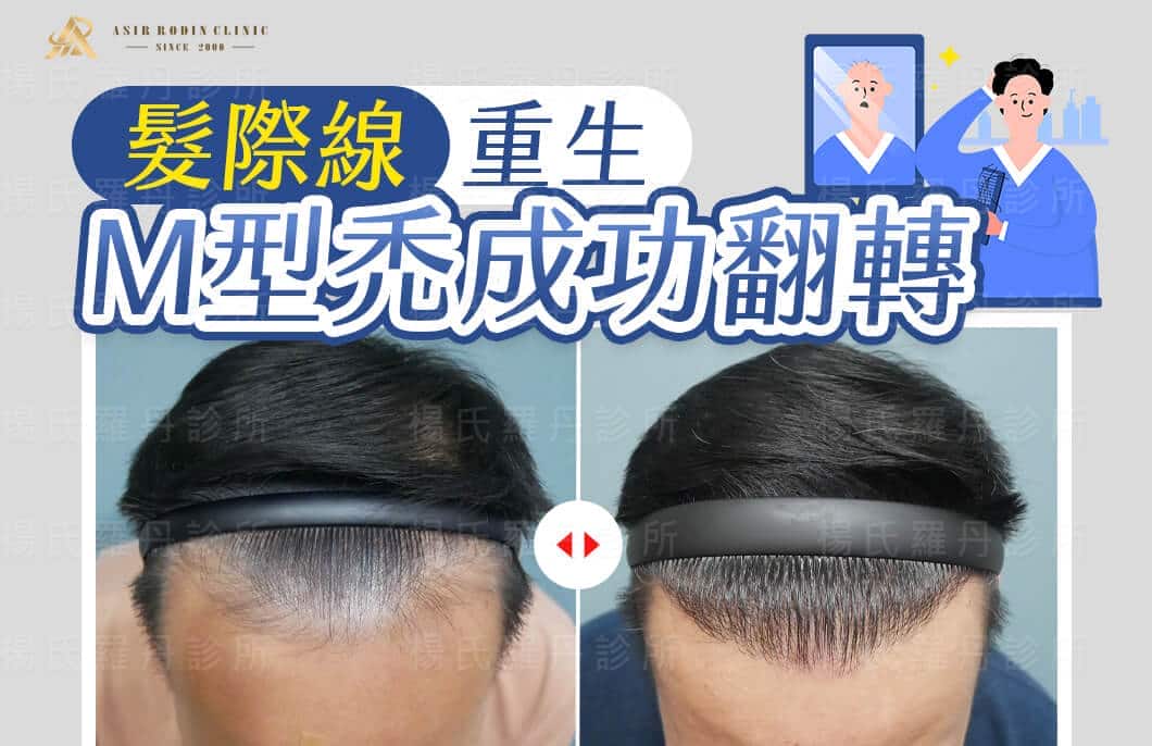 【植髮】M型禿成功翻轉，髮際線重生展現滿滿自信與風采