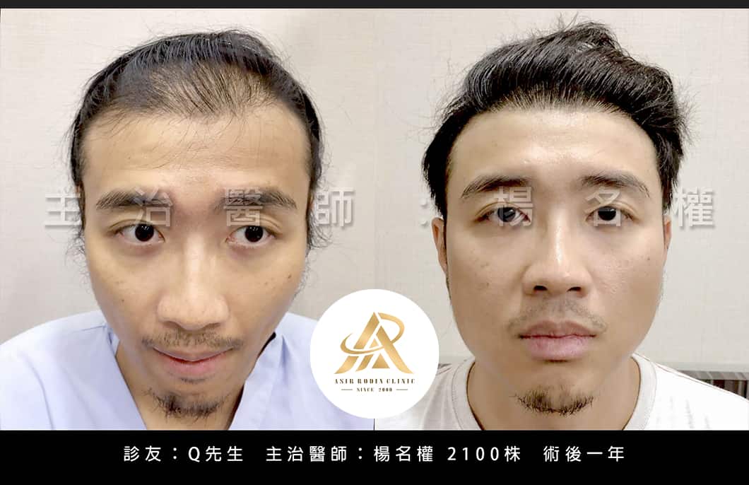 【植髮】讓外表年輕十歲的秘密是？