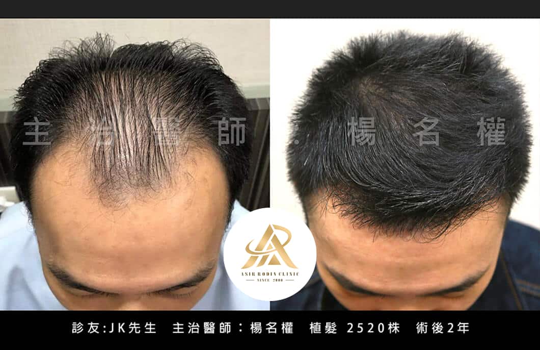 【植髮】「不髮」份子的重生！