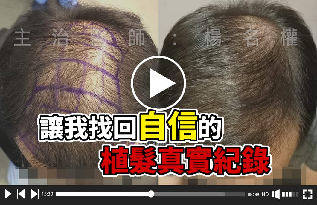 【植髮】落髮、禿頭不焦慮，讓我找回自信的植髮真實紀錄