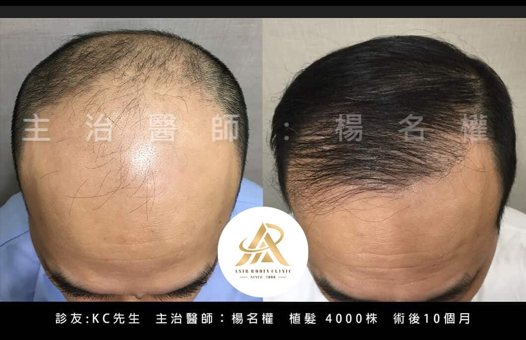 【植髮】有限範圍裡的近乎完美！