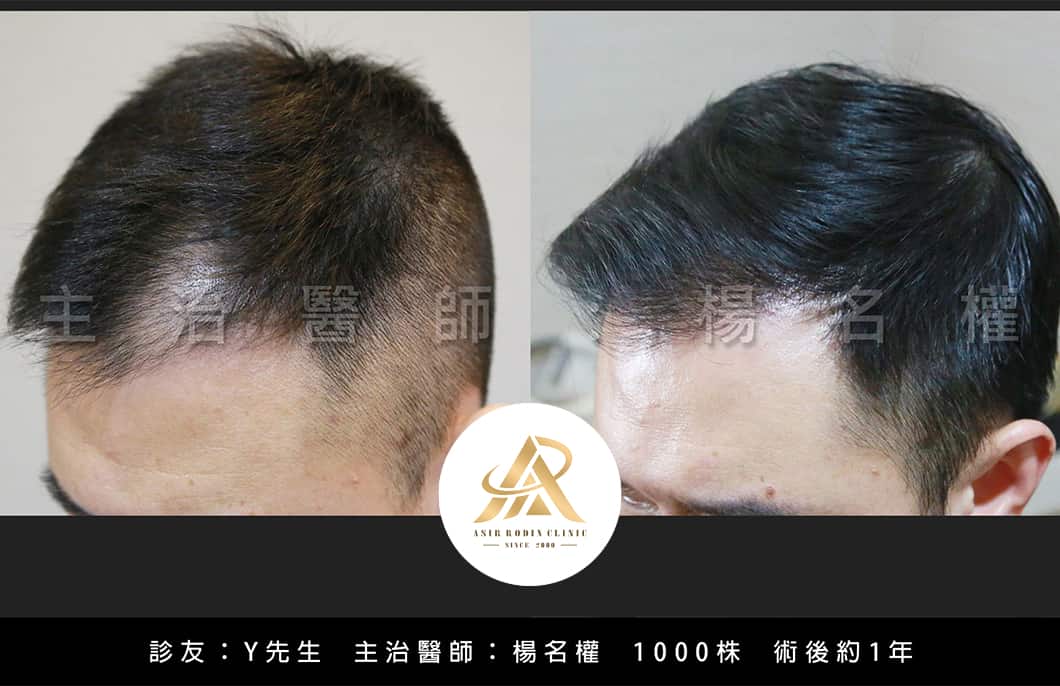 【植髮】楊名權醫師：『男人的小遺憾大面子！』