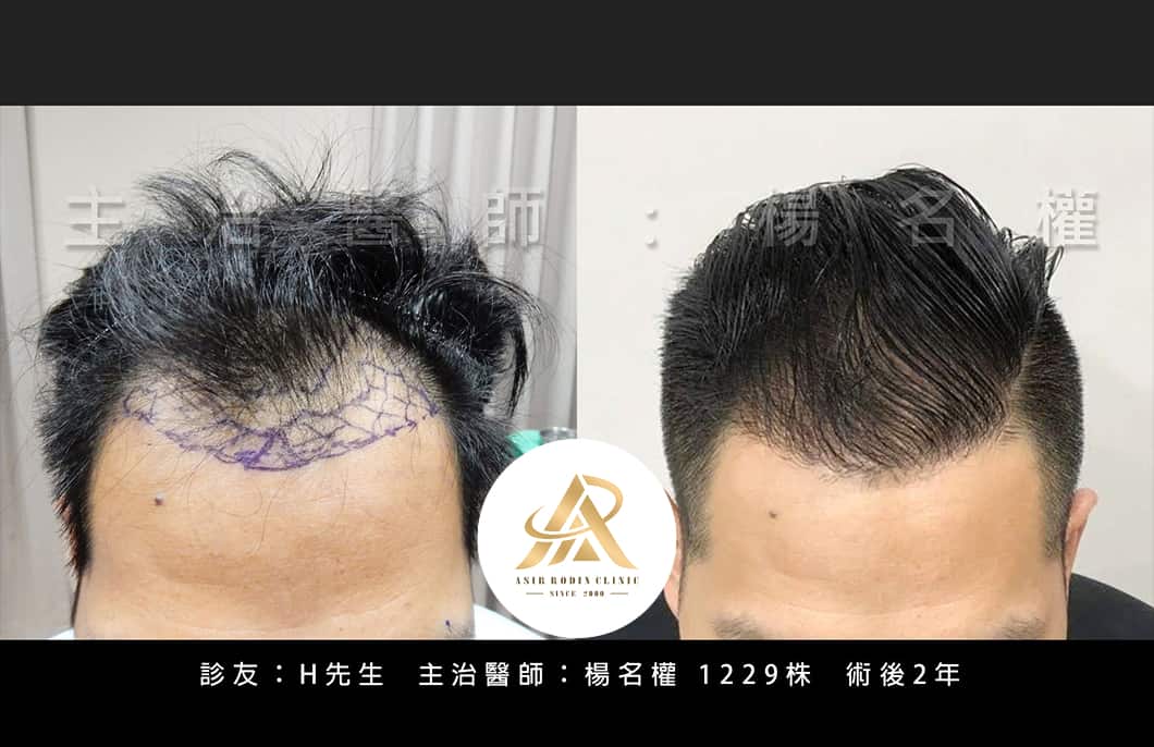 【植髮】「植」多少？由專業為您評估！