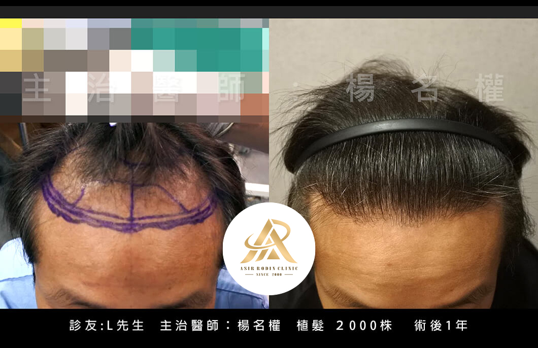 【植髮】戒菸保髮，一起顧健康！