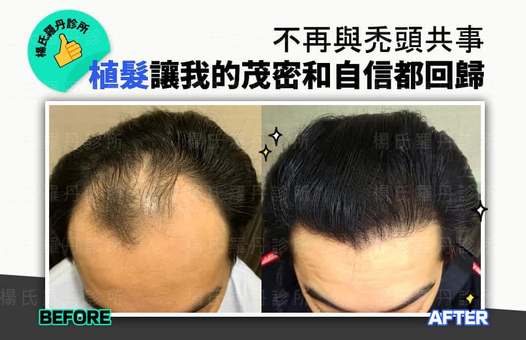 【植髮】不再與禿頭共事，植髮讓我的茂密和自信都回歸