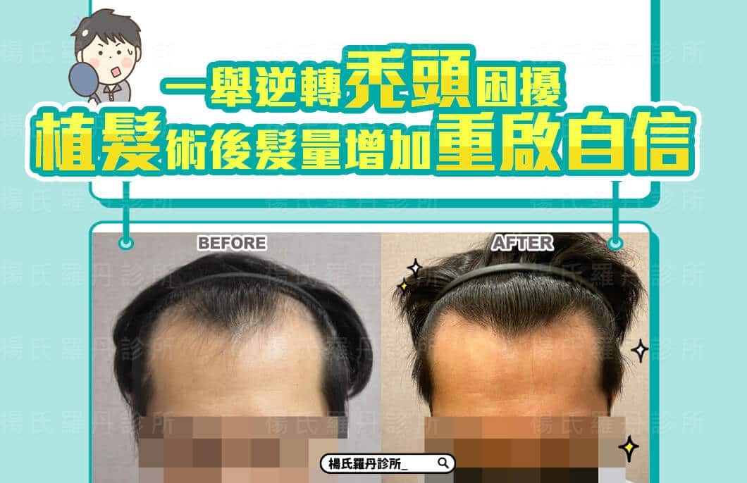 【植髮】一舉逆轉禿頭困擾，植髮術後髮量增加重啟自信