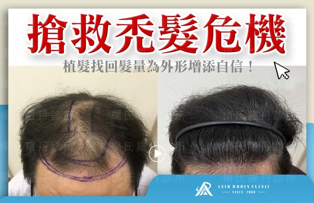 【植髮】搶救禿髮危機，植髮找回髮量為外形增添自信！