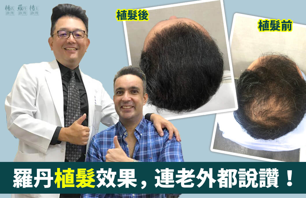 【植髮】羅丹複合式生髮與植髮效果，連老外都說讚！