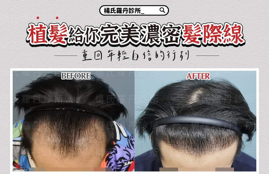 【植髮】植髮給你完美濃密髮際線，重回年輕自信的行列