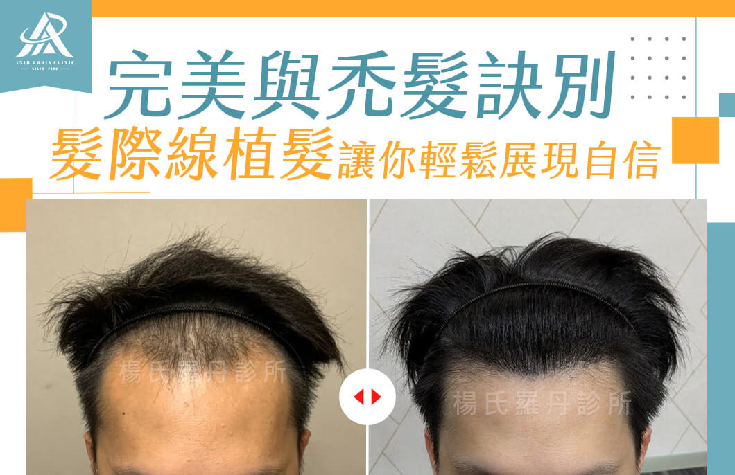 【植髮】完美與禿髮訣別，髮際線植髮讓你輕鬆展現自信