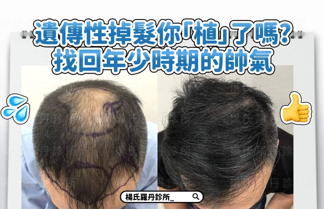 【植髮】遺傳性掉髮你「植」了嗎?找回年少時期的帥氣