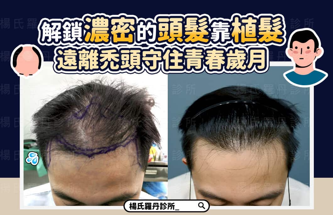 【植髮】解鎖濃密的頭髮靠植髮，遠離禿頭守住青春歲月