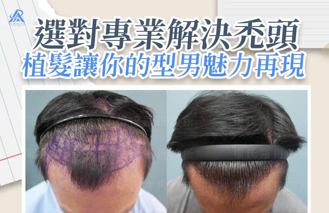 【植髮】選對專業解決禿頭，植髮讓你的型男魅力再現！