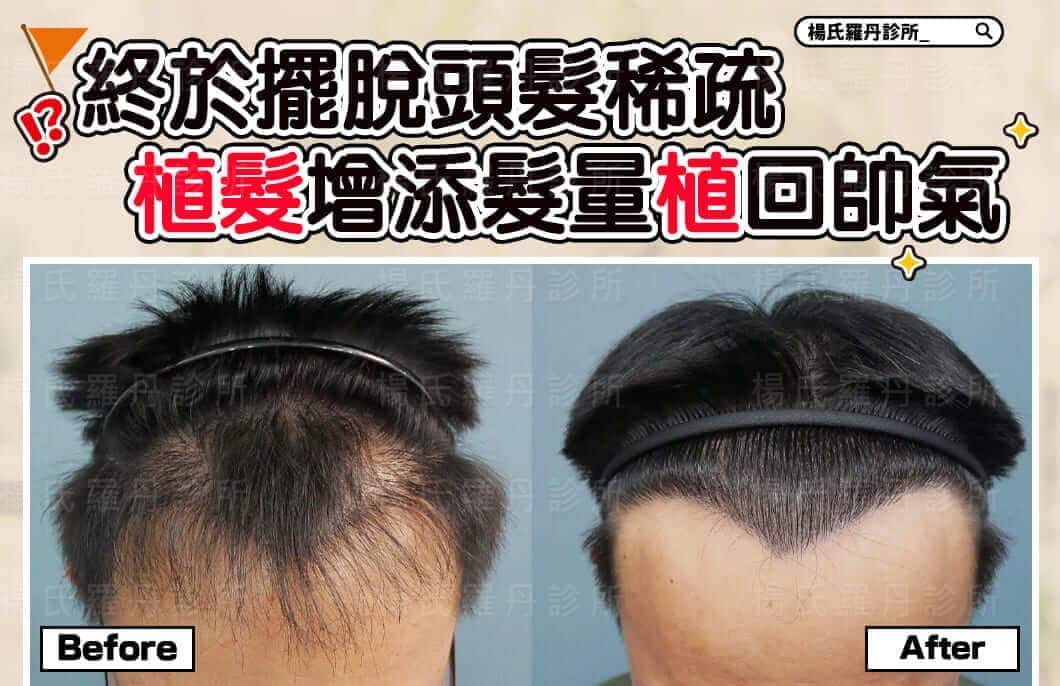 【植髮】終於擺脫頭髮稀疏，植髮手術增添髮量植回帥氣