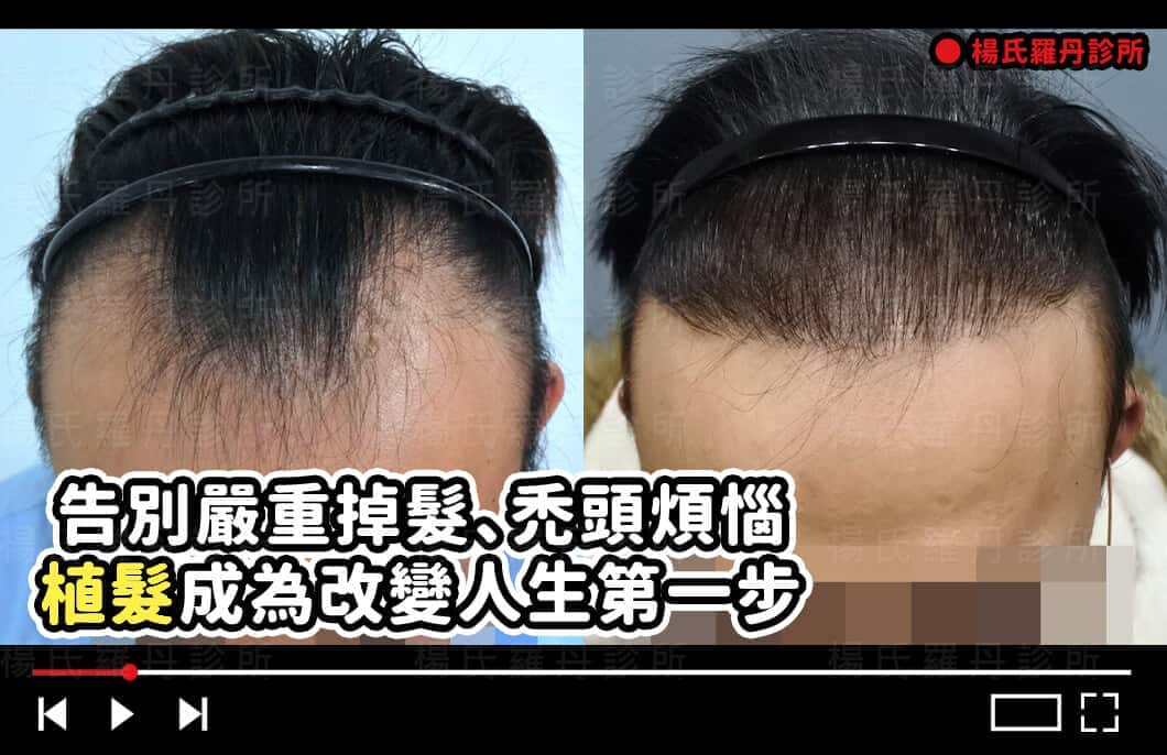 【植髮】告別嚴重掉髮、禿頭煩惱，植髮成為改變人生第一步