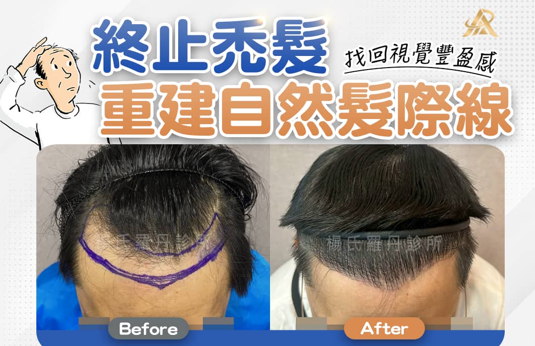 【植髮】終止禿髮惡夢，重建自然髮際線找回視覺豐盈感