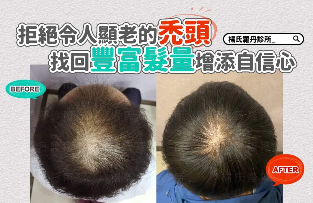 【植髮】拒絕令人顯老的禿頭，找回豐富髮量增添自信心