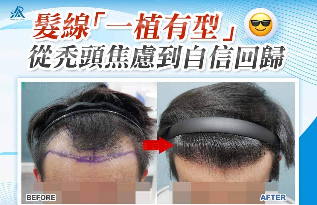 【植髮】從禿頭焦慮到自信回歸，型男髮線一植有型在線