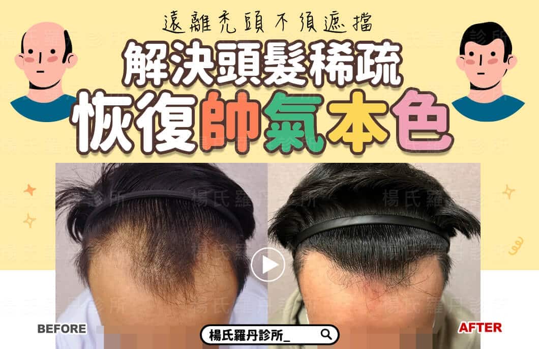 【植髮】遠離禿頭不須遮擋，解決頭髮稀疏恢復帥氣本色