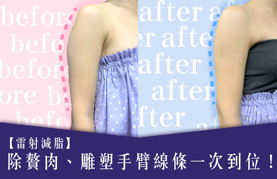 【雷射減脂】除贅肉、雕塑手臂線條一次到位！