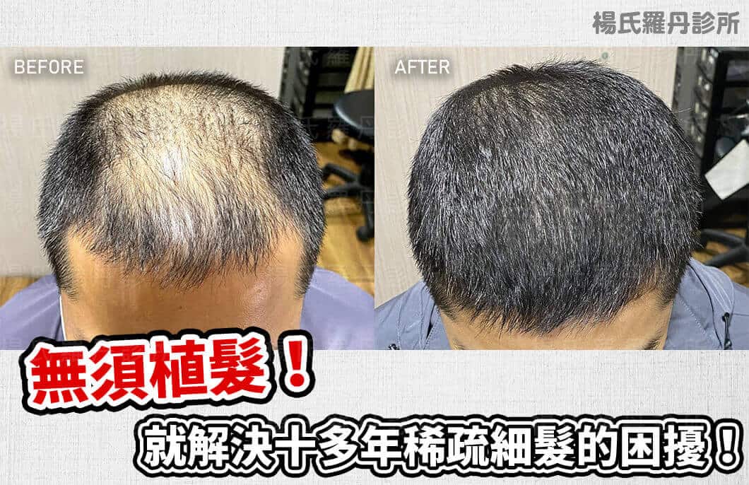 【複合式生髮】無須植髮！就解決十多年稀疏細髮的困擾！