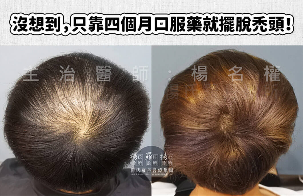 【複合式生髮】沒想到，只靠四個月口服藥療程就擺脫禿頭！