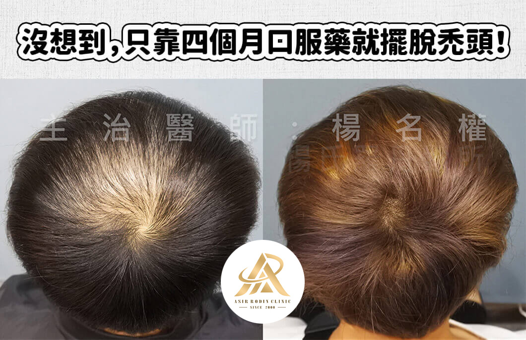 【複合式生髮】沒想到，只靠四個月口服藥療程就擺脫禿頭！