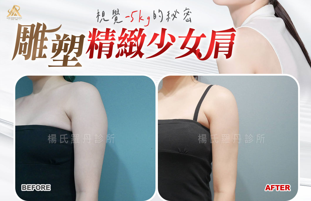 【雷射減脂】視覺顯瘦五公斤的秘密，雕塑精緻少女直角肩