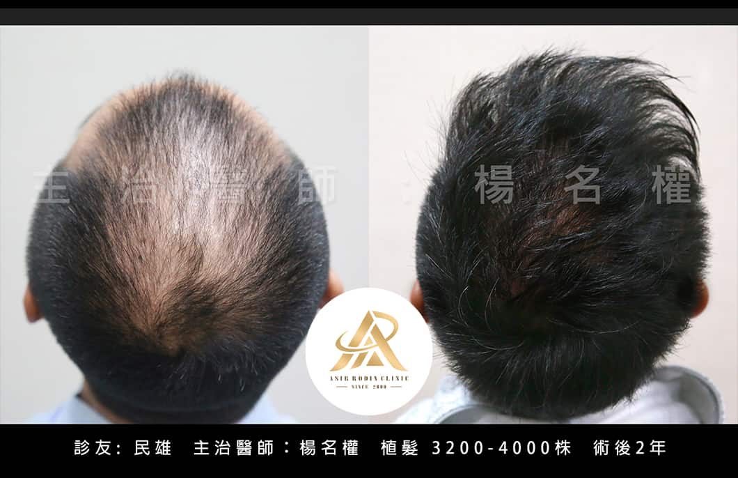【植髮】楊名權醫師：真的假不了！
