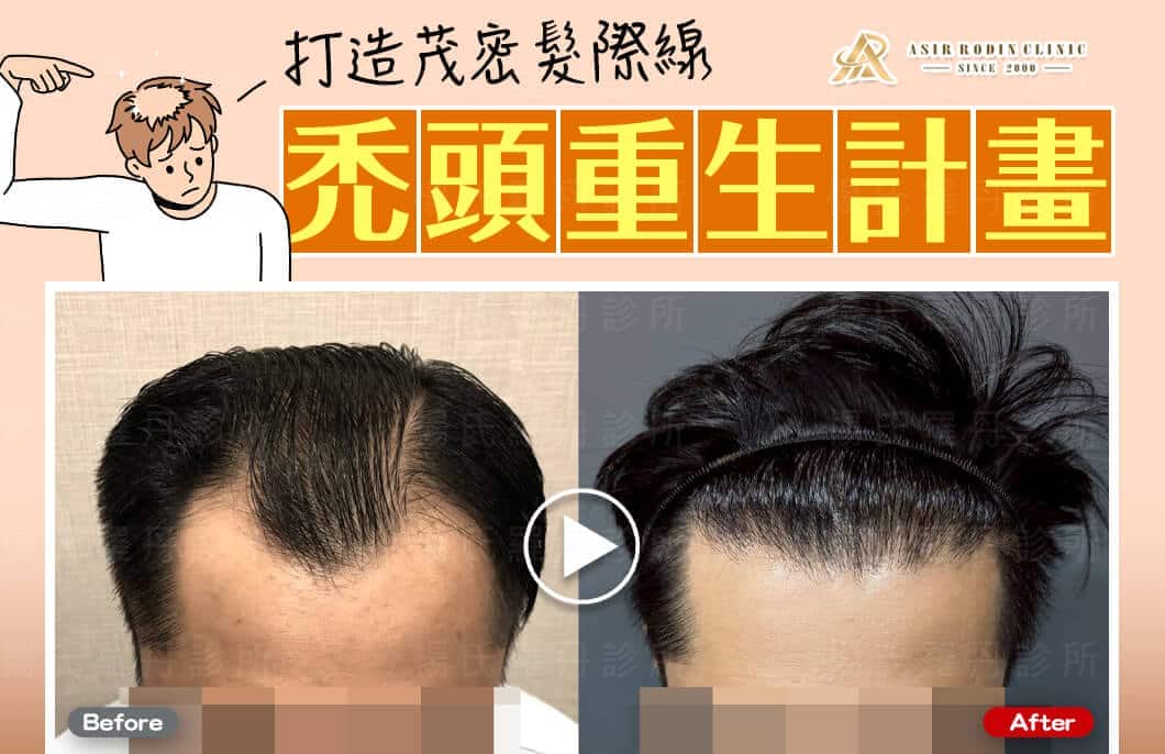 【植髮】禿頭重生計畫，打造茂密髮際線再現年輕改變！