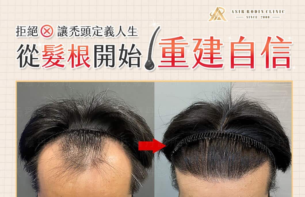 【植髮】拒絕讓禿頭定義人生，從稀疏髮根開始重建自信