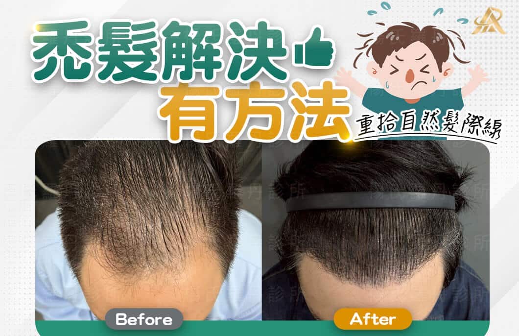 【植髮】禿髮解決有方法，重拾自然髮際線找回自在的自己